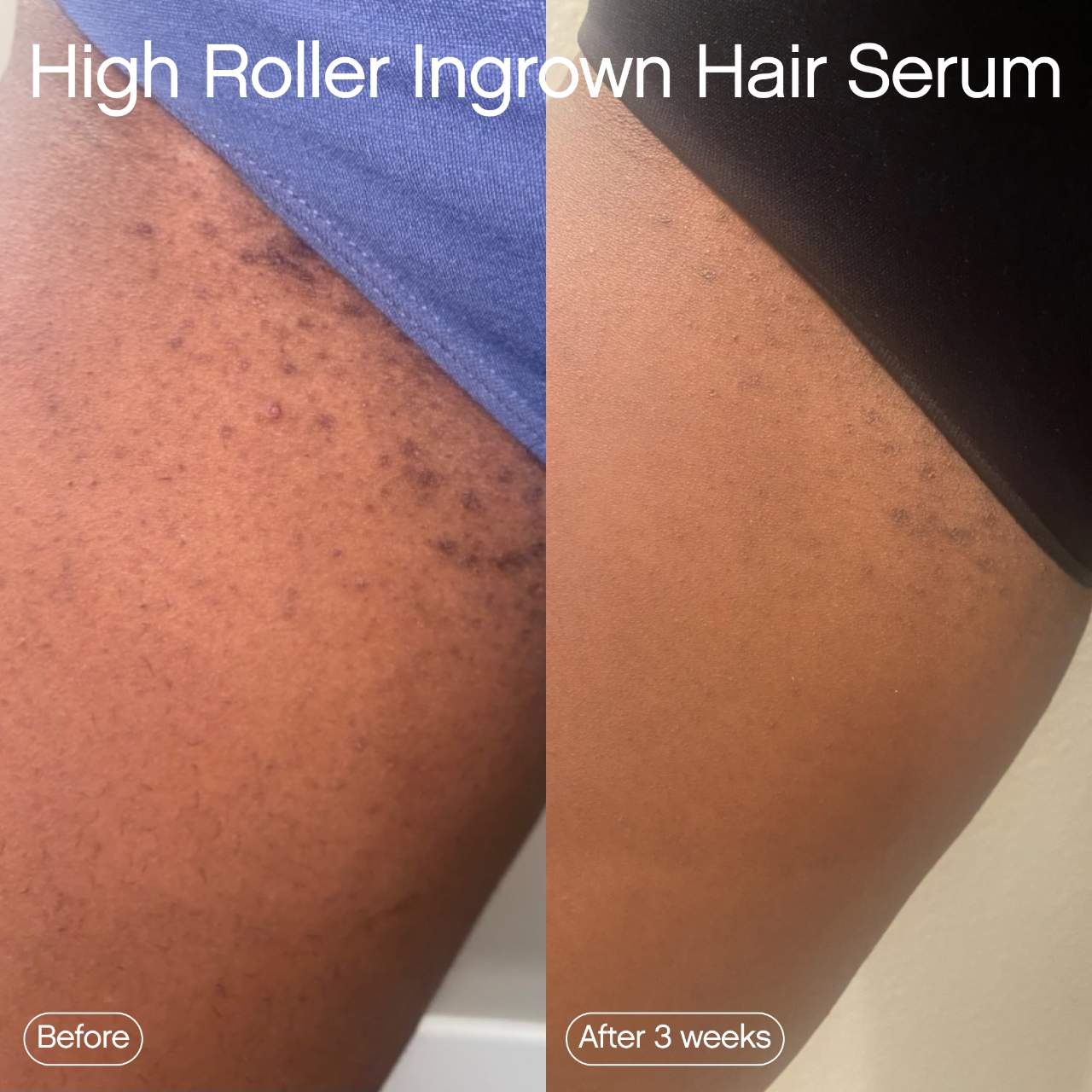 SUMMER PROMOTION - Smoothing Solution Ingrown Hair Treatment