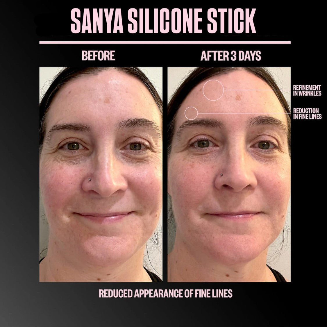 Sanya Scar Stick Treatment Solution