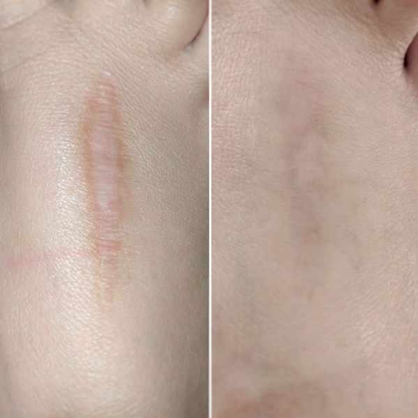 Sanya Scar Stick Treatment Solution