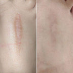 Sanya Scar Stick Treatment Solution